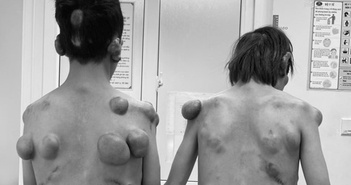 Phẫu thuật cho hai anh em sinh đôi có khối u cơ thể khổng lồ với hàng trăm khối u được thực hiện.