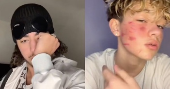 Thử thách độc hại "French scar" khiến TikTok bị điều tra Thử thách độc hại "French scar" khiến TikTok bị điều tra