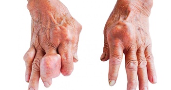 Vì sao người bệnh gout có các nốt sần dưới da?