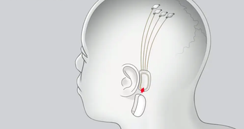 Triển vọng thử nghiệm cấy chip của công ty Neuralink Triển vọng thử nghiệm cấy chip của công ty Neuralink