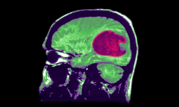 U não có thể được điều trị nhanh chóng và chính xác hơn với sự trợ giúp của trí tuệ nhân tạo.
