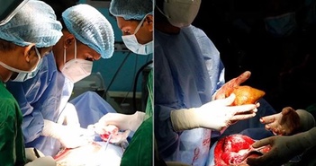 Phẫu thuật loại bỏ viên sỏi thận lớn nhất thế giới