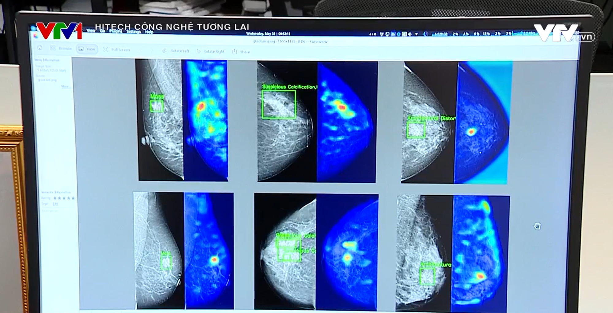 Ứng dụng AI giúp phát hiện ung thư vú qua sàng lọc nhũ ảnh - Ảnh 2.