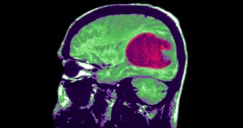 Trí tuệ nhân tạo có thể điều trị u não nhanh và chính xác hơn
