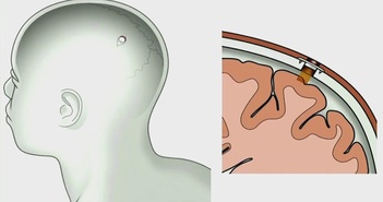 Neuralink của tỉ phú Elon Musk đã cấy chip vào não người Neuralink của tỉ phú Elon Musk đã cấy chip vào não người