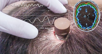 Elon Musk: Người đầu tiên được cấy chip Neuralink vào não đã điều khiển được chuột máy tính 'chỉ bằng suy nghĩ' Elon Musk: Người đầu tiên được cấy chip Neuralink vào não đã điều khiển được chuột máy tính 'chỉ bằng suy nghĩ'