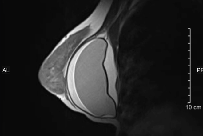 Hình ảnh chụp MRI cho thấy ngực trái bệnh nhân bị vỡ túi ngực, có nhiều dịch (Ảnh: BSCC)