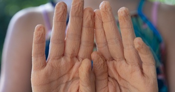 Phát hiện bất ngờ về hiện tượng ngón tay nhăn nheo khi ngâm nước Phát hiện bất ngờ về hiện tượng ngón tay nhăn nheo khi ngâm nước