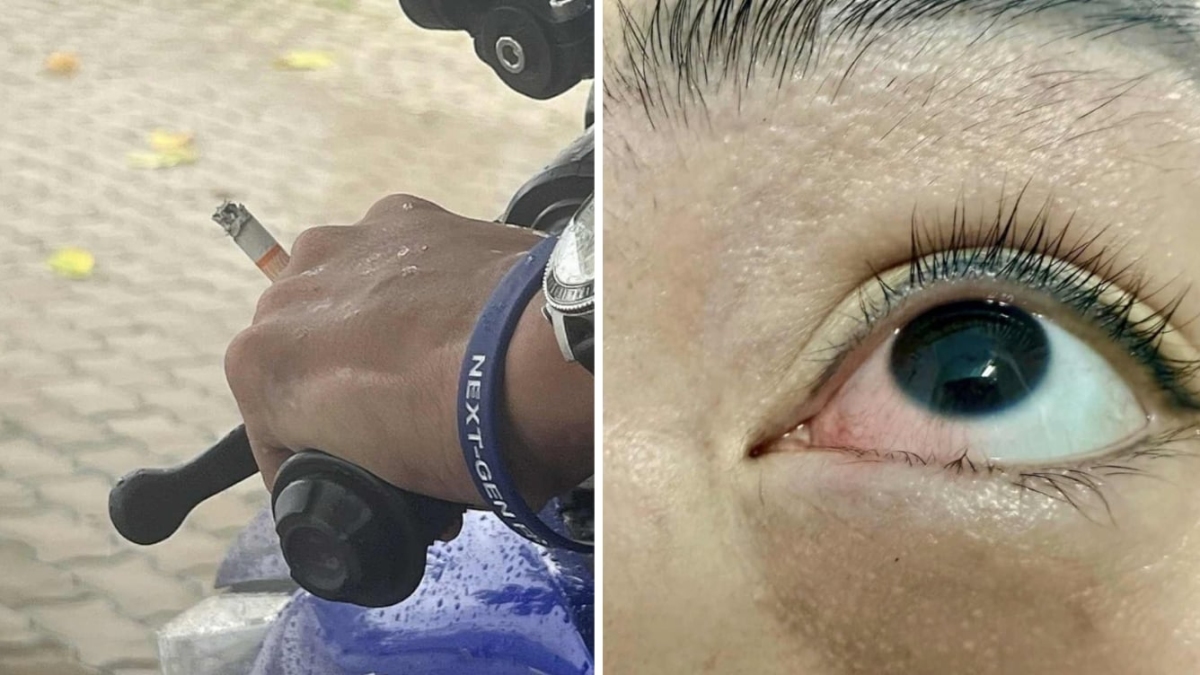 Bỏng mắt vì tàn thuốc văng trúng khi lái xe