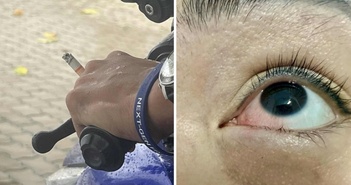 Bỏng mắt vì tàn thuốc văng trúng khi lái xe Bỏng mắt vì tàn thuốc văng trúng khi lái xe